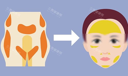 脂肪填充动画图