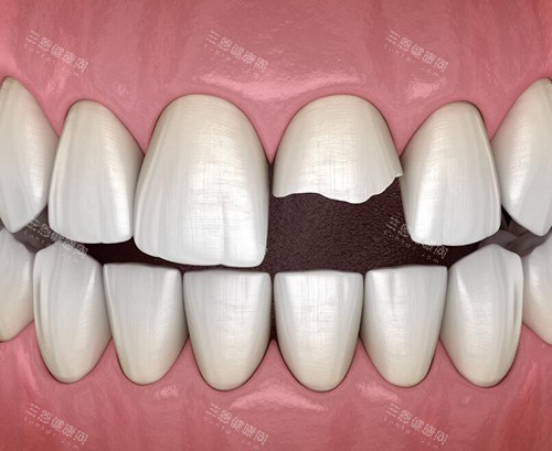 牙齿缺损图