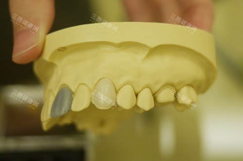 牙齿模具 牙齿模具
