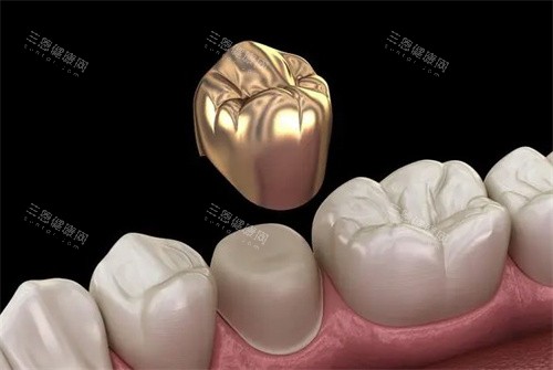 牙冠的材质 牙冠的材质