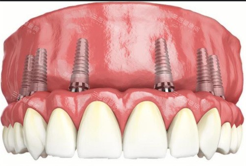 全口种植牙动画示意图 全口种植牙动画示意图