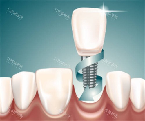 种植牙在口腔图 种植牙在口腔图
