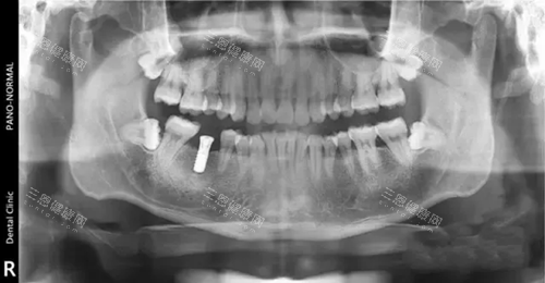 瑞士士卓曼种植体X光片.webp 瑞士士卓曼种植体X光片.webp