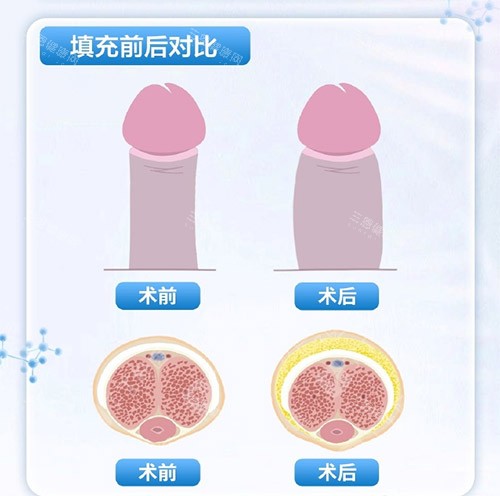 填充增大增粗示意图