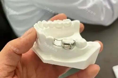 儿童牙齿间隙保持器 儿童牙齿间隙保持器