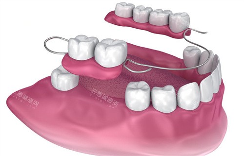 可移动部分假牙 可移动部分假牙