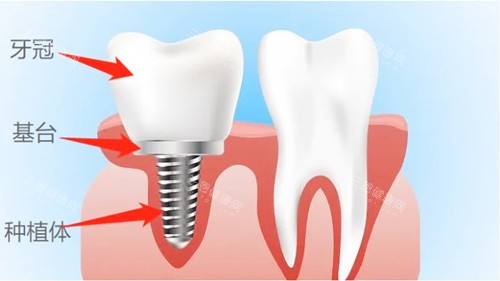 种植牙卡通图示 种植牙卡通图示