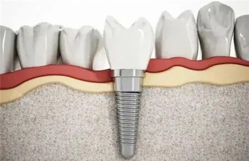 种植牙动画图片 种植牙动画图片