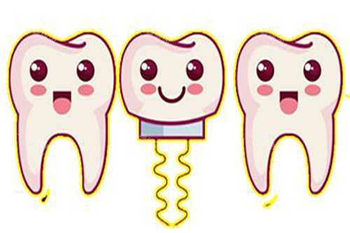 种植牙卡通示意图 种植牙卡通示意图