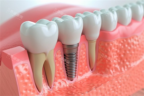 种植牙与正常牙齿模型对比漫画图 种植牙与正常牙齿模型对比漫画图