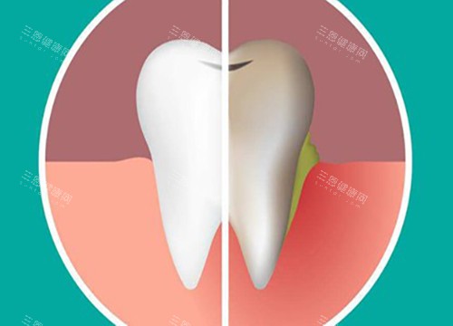 美白牙齿对比 美白牙齿对比