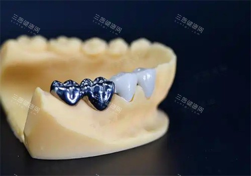 纯钛一体冠牙齿 纯钛一体冠牙齿