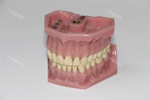 牙齿模型示意图 牙齿模型示意图