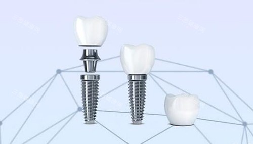 口腔种植牙改善 口腔种植牙改善