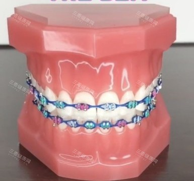 牙齿矫正牙套模型示意图 牙齿矫正牙套模型示意图