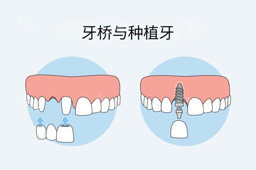 牙冠桥和种植牙对比图