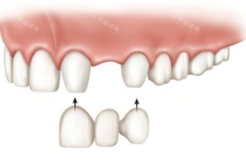 镶牙安装卡通图 镶牙安装卡通图