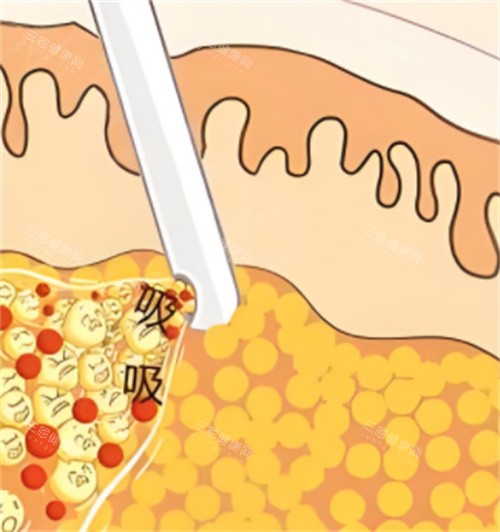 深圳阳光整形吸脂多少钱?6800-3.2W元起,部位/技术/医生报价差异点击看!