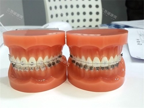 牙齿矫正牙套模型 牙齿矫正牙套模型