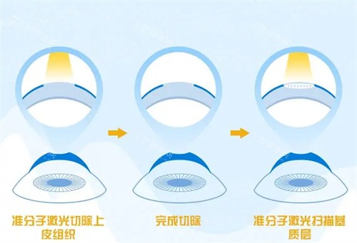 不同的近视手术