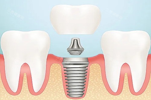 口腔种植牙卡通示意图 口腔种植牙卡通示意图