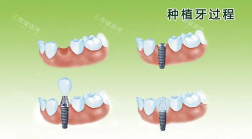 种植牙过程图片 种植牙过程图片
