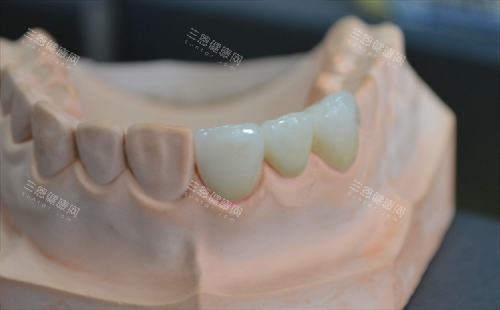安装在牙齿模型上的全瓷牙成效 安装在牙齿模型上的全瓷牙成效