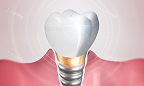 种植牙动画图 种植牙动画图