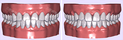 牙齿矫正模拟图前后对比