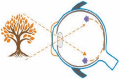 佩戴角膜塑形镜视物