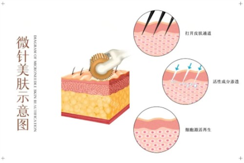 黄金微针多久做一次成效更佳？一般建议6个月做一次比较好、且维持时间更久