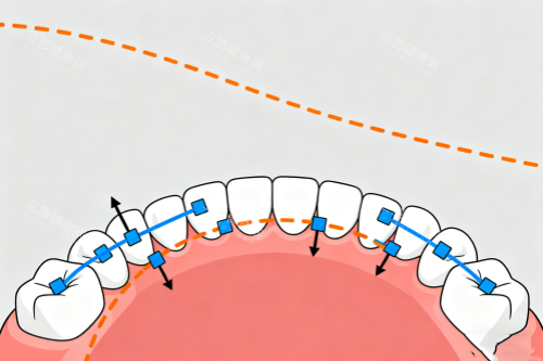 牙齿矫正概念图 牙齿矫正概念图