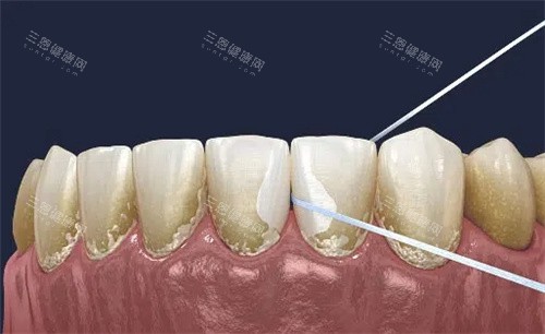 牙线清理牙齿缝隙