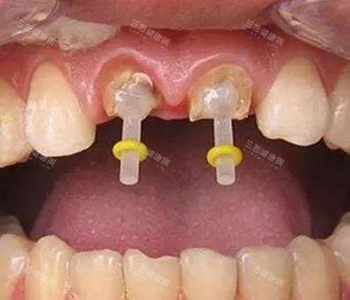 沂南看牙选哪家？爱中/刘如学等3家本地老牌牙科对比，种牙矫正修复找他们准没错！