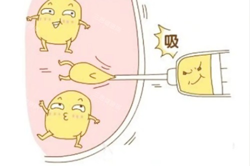 吸脂卡通展示图