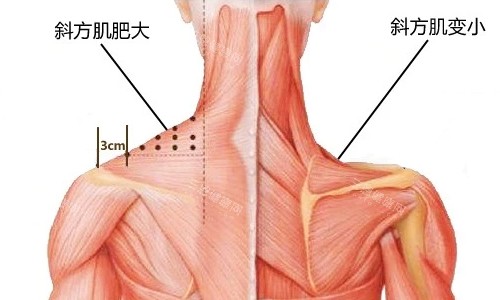 斜方肌注射前后展示图 斜方肌注射前后展示图