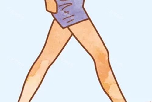 韩国断骨加高手术成熟吗？费用50万是真的吗？风险与结果深度分析！