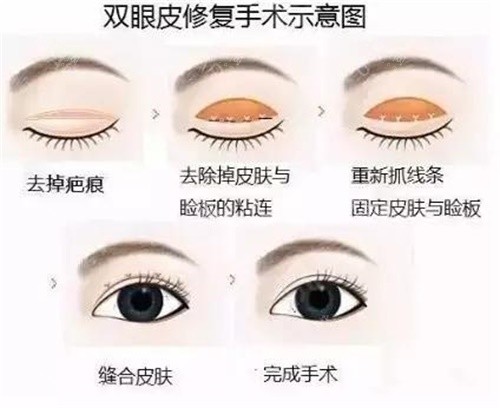 欧阳黎平医生改单眼皮技术如何？双眼皮手术术例对比，术后结果大公开！