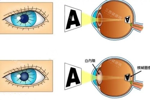 麦迪格和爱尔眼科哪个好？虽都是连锁品牌但在价格&设备等方面会有差异！近视眼手术