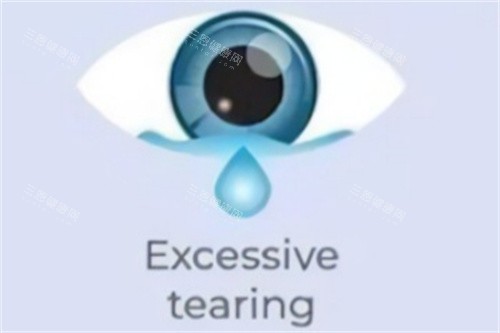 眼睛多泪示意图