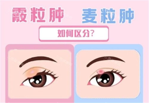 爱尔眼科麦粒肿手术费用揭秘！市场价格500元起，术后护理注意事项全在这里！