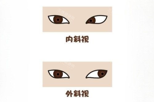 2026年斜视手术价格大全！内斜视5000元起/外斜视7000元起，手术方式+修复指南！