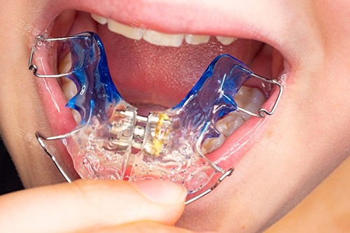 牙齿矫治器示意图 牙齿矫治器示意图