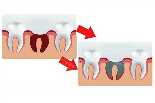拔牙后牙洞发灰发臭？干槽症vs正常愈合对比图来了！手把手教你3天自检避坑~