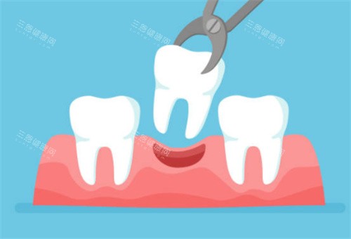 牙齿拔牙示意图