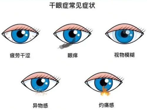 干眼症症状图 干眼症症状图