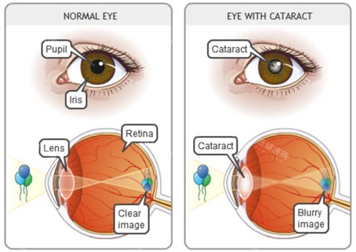 晶体置换晶体和眼睛的表现 晶体置换晶体和眼睛的表现