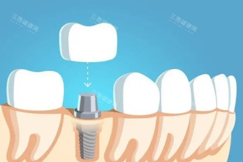 种植牙戴牙冠卡通图 种植牙戴牙冠卡通图