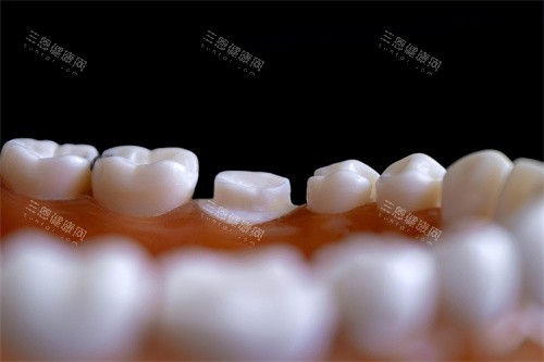 牙冠展示宣传图 牙冠展示宣传图