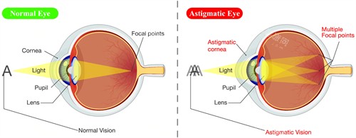 散光眼睛看不清楚东西的原理 散光眼睛看不清楚东西的原理